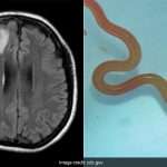 World's First Live Parasite Found In Australian Woman's Brain