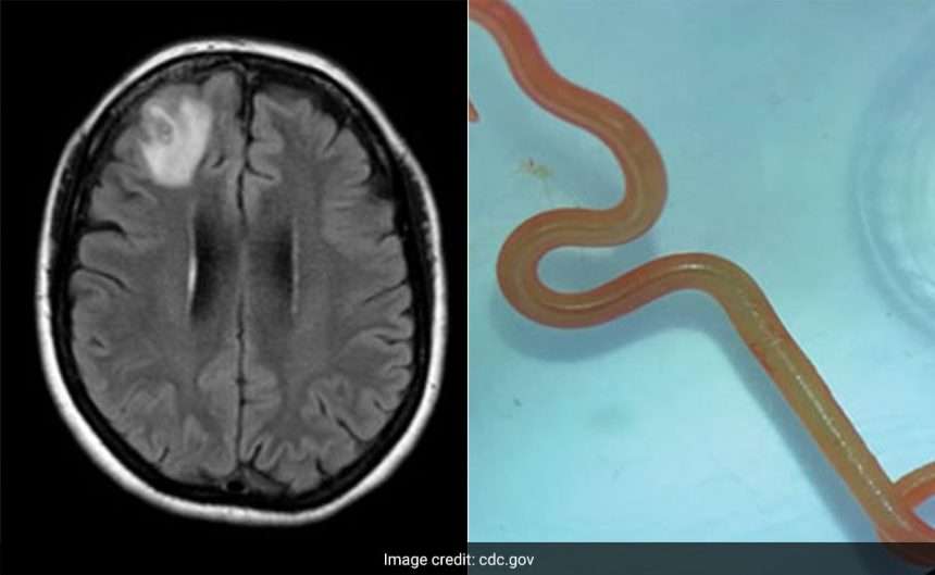 World's First Live Parasite Found In Australian Woman's Brain