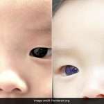Baby's Dark Brown Eyes Turn Blue After Covid 19 Treatment In