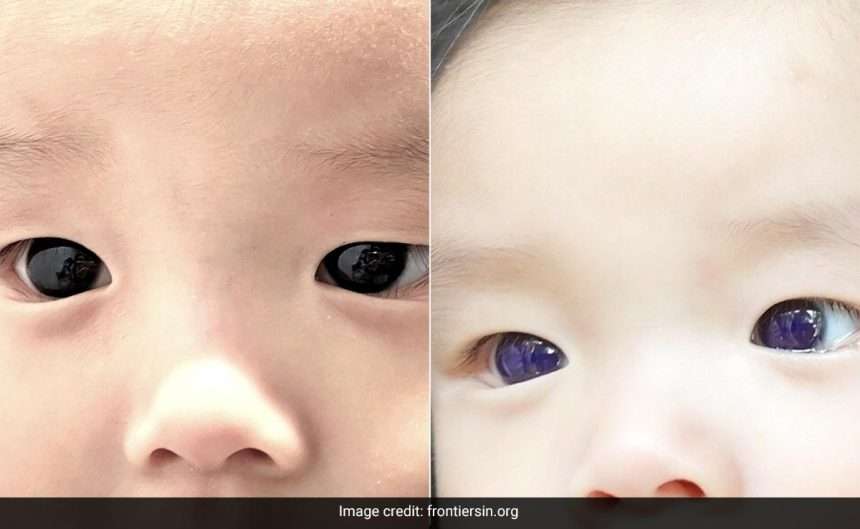 Baby's Dark Brown Eyes Turn Blue After Covid 19 Treatment In
