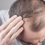Baldness Breakthrough – Scientists Discover 5 Important Genes