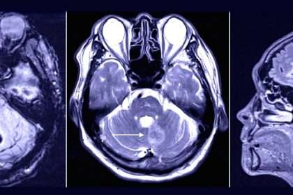 Dentist Visit May Have Caused Patient's Rare Brain Bleed: Sciencealert