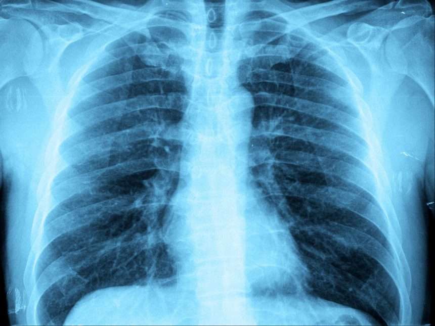 How Is "white Lung Syndrome" Different From The Chinese Pneumonia