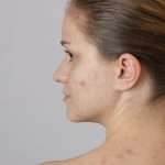People With Acne Are Less Likely To Be Hired, Dated