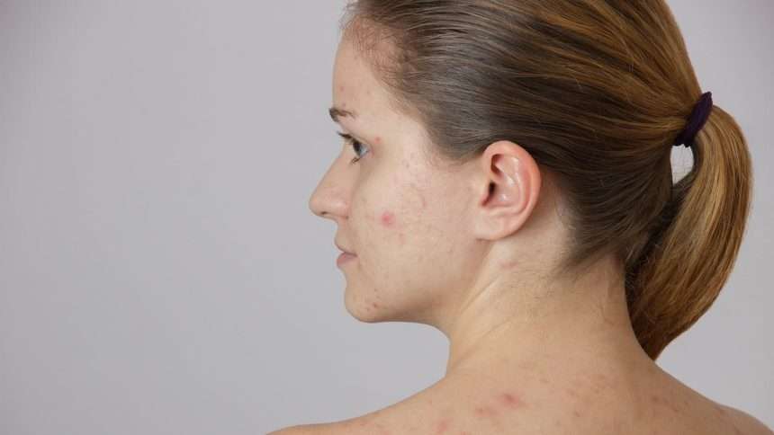 People With Acne Are Less Likely To Be Hired, Dated