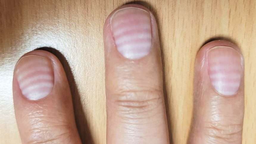 Strange White Lines On Man's Nails Turned Out To Be