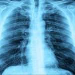 What Is "white Lung Pneumonia" Affecting Children In Ohio? Signs,