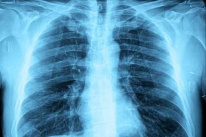 What Is "white Lung Pneumonia" Affecting Children In Ohio? Signs,