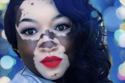 A 43 Year Old Black Woman With Vitiligo Claims Her Skin Condition