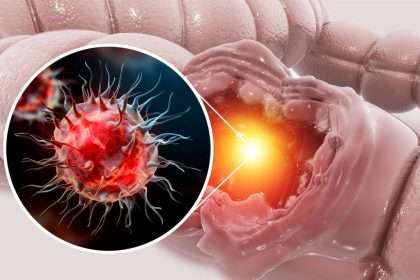 Colon Cancer Could Be Stopped By Turning On Proteins 'like