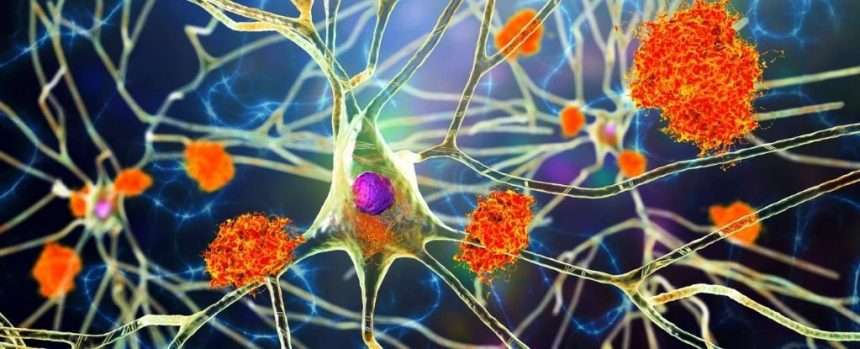 Groundbreaking Alzheimer's Disease Discovery Reveals Five Distinct Variants: Sciencealert