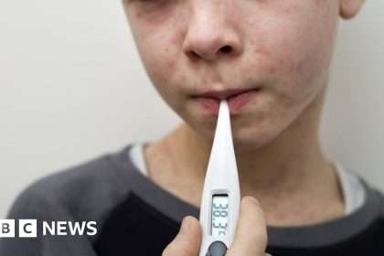 Measles: Why Are Infections Increasing And What Are The Symptoms?