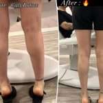 Ozempic On Your Feet? 'calf Tox' Is Tiktok's Latest Slimming