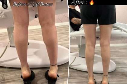 Ozempic On Your Feet? 'calf Tox' Is Tiktok's Latest Slimming