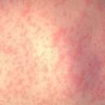 Philadelphia Warns Of Measles Outbreak After Infected Child Sent To