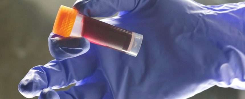 Scientists Find Blood Type Affects Early Stroke Risk: Sciencealert