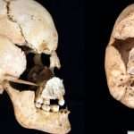 Scientists Identify First Known Prehistoric Person With Turner Syndrome