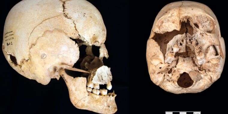 Scientists Identify First Known Prehistoric Person With Turner Syndrome