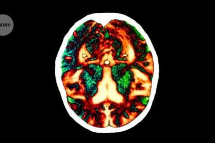 Signs Of 'contagious' Alzheimer's Disease Seen In People Treated With