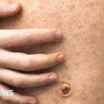 Students Urged To Be Careful About Measles After Outbreak In