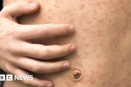 Students Urged To Be Careful About Measles After Outbreak In