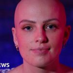 Alopecia: Woman Says She Can't Look Herself In The Mirror
