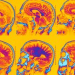 Brain Scans Identify Six Different Types Of Depression And Anxiety