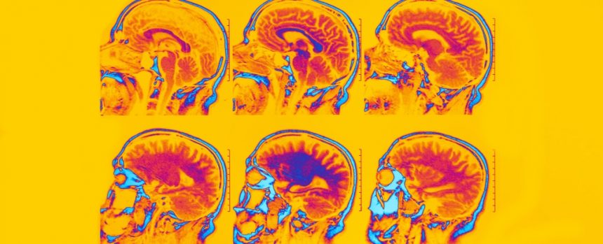 Brain Scans Identify Six Different Types Of Depression And Anxiety