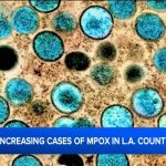 Chickenpox Cases On The Rise In Los Angeles County; Health