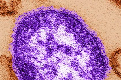 Measles Outbreak Triggers Exposure Alert In Three N.h. Locations